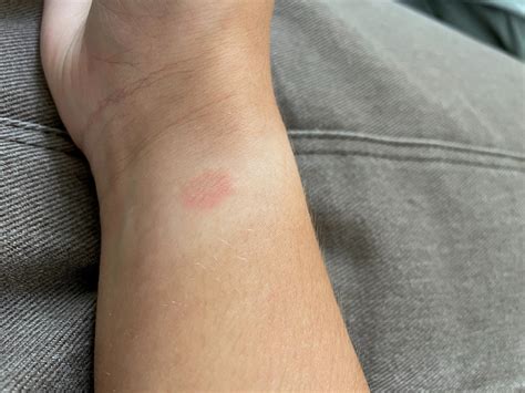 fake watch cause itchy rash